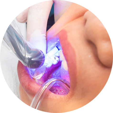 The Cosmetic Bonding Process