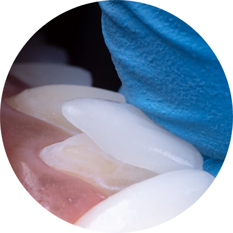 Veneers