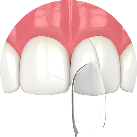 Cosmetic Bonding