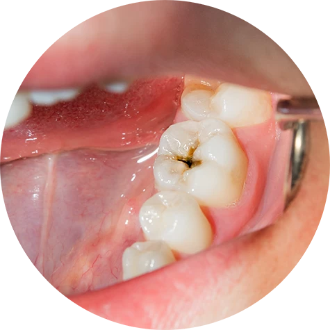 The Dental Crown Process