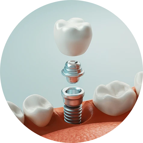 What are Dental Implants?