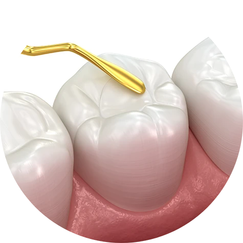 What are Dental Sealants?