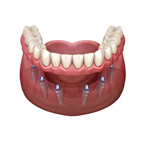 What are the Benefits of an Implant Denture?
