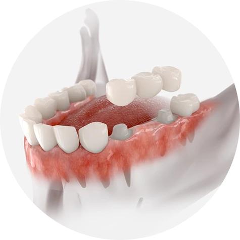 Dental Bridges
