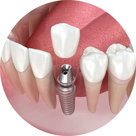 Dental Implants