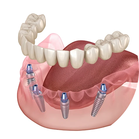 Full Mouth Reconstruction