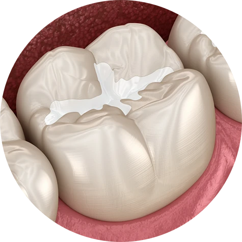 Dental Sealants