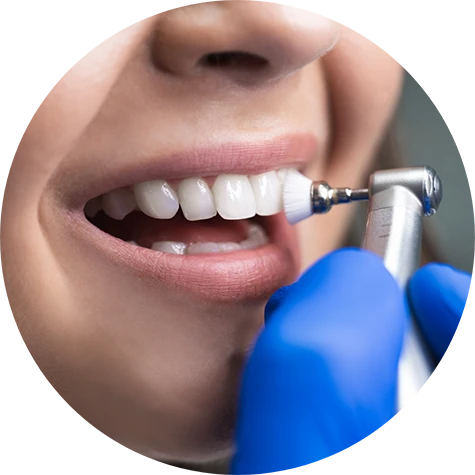 Fluoride Treatment