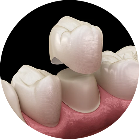 Dental Crowns