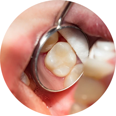 Tooth-Colored Fillings