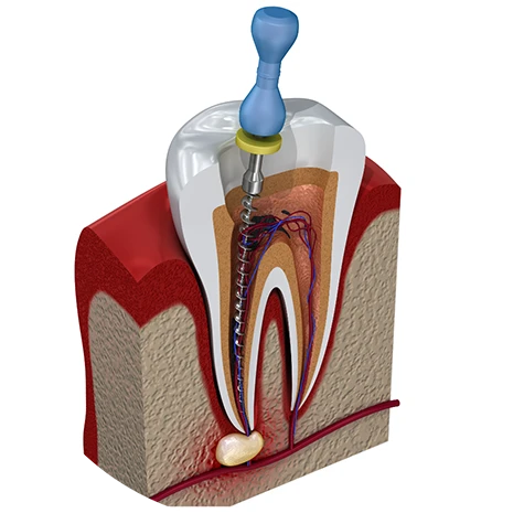 Restore Your Smile & Save Your Tooth