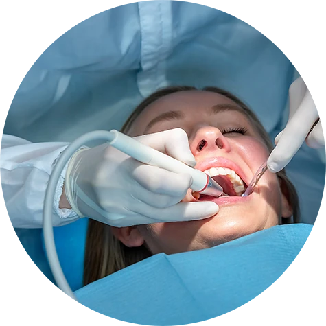 Benefits of Silver Diamine Fluoride (SDF)